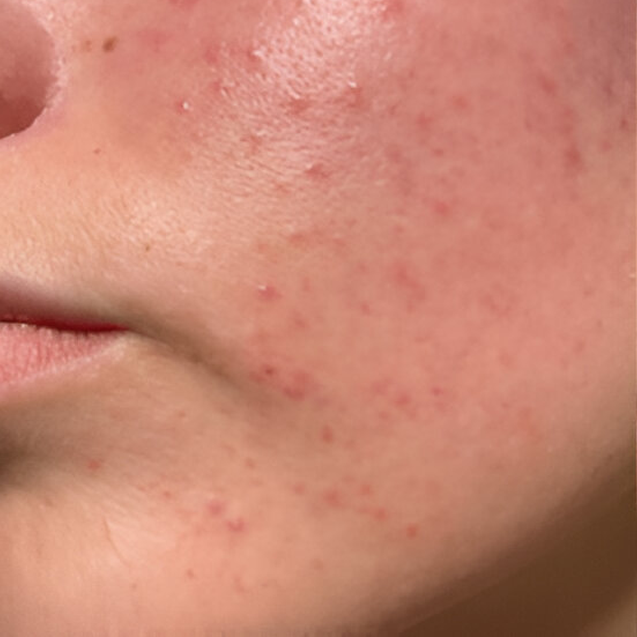 Acne control