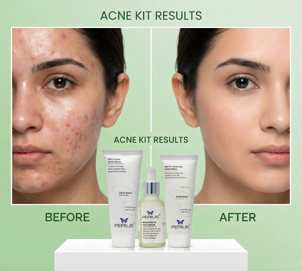 Before and after comparison of a woman's face with acne treatment products displayed.