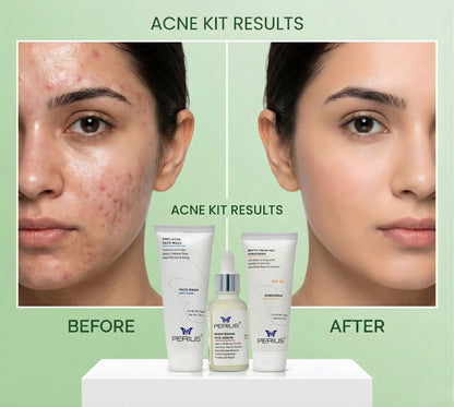 Before and after comparison of a woman's face with acne treatment products displayed.